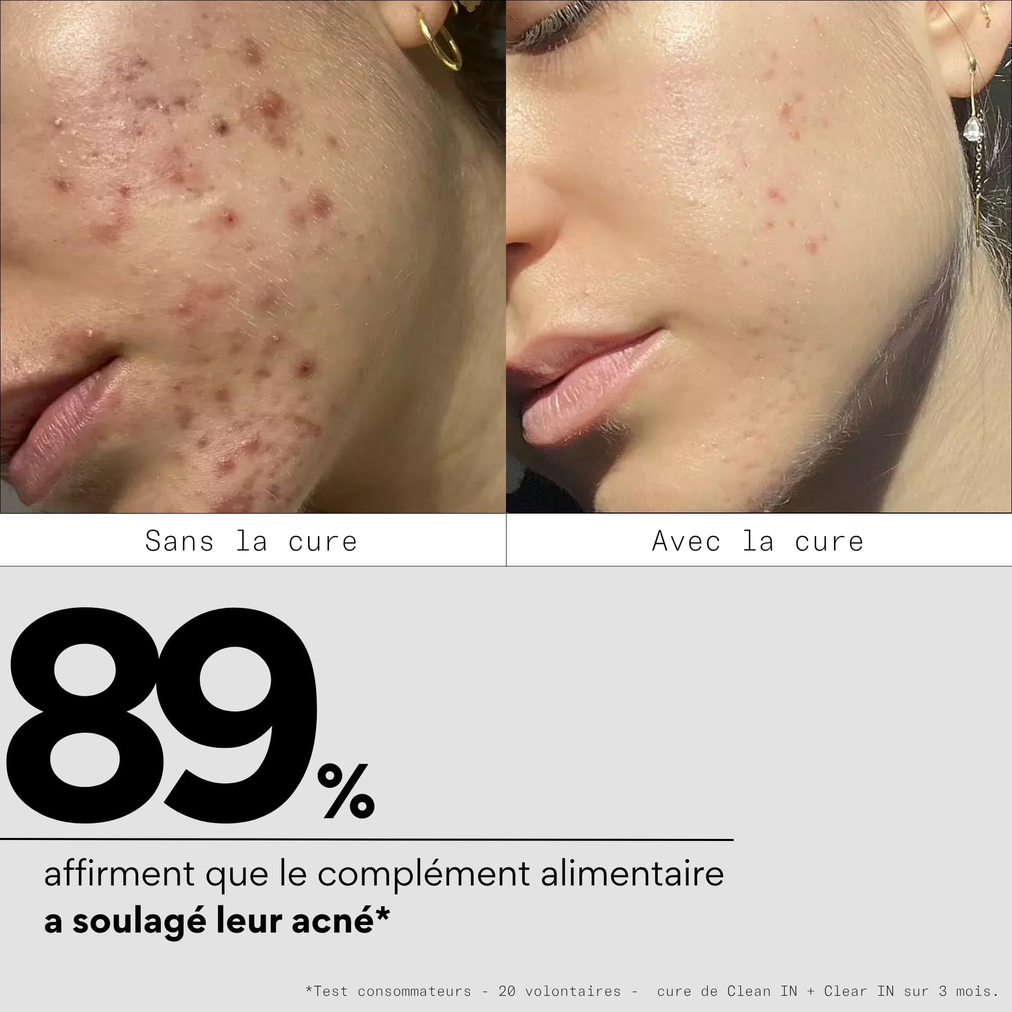 Skin & Out - Complément Alimentaire Stop-Boutons - Complément Alimentaire Nettoyant