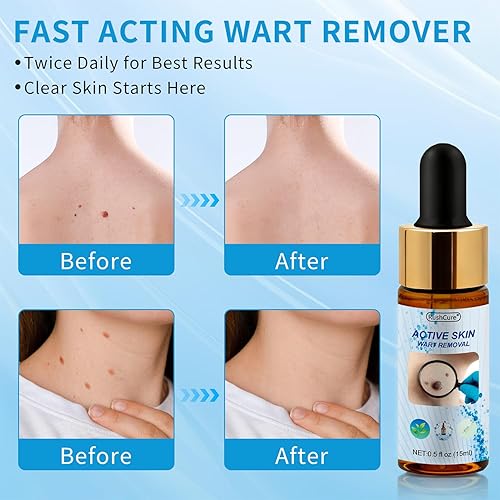 Miniatura 6 de RushCure Eliminación de verrugas cutáneas con 17% de ácido salicílico, suero removedor de lunares con gotero de precisión, removedor de marcas