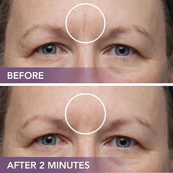 Dermaflage Scar Filler Kit - Light - Deep Scar Cover and Waterproof Concealer for Acne Scars Wrinkles, and Ice Pick Scars Makeup, 1 mo supply