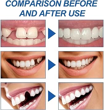 Temporary Tooth Filling Repair Kit - Tooth Filling Repair Kit with False Teeth to Fix Broken or Missing Teeth, Bridges Gaps and Replaces Chipped Dental Structures