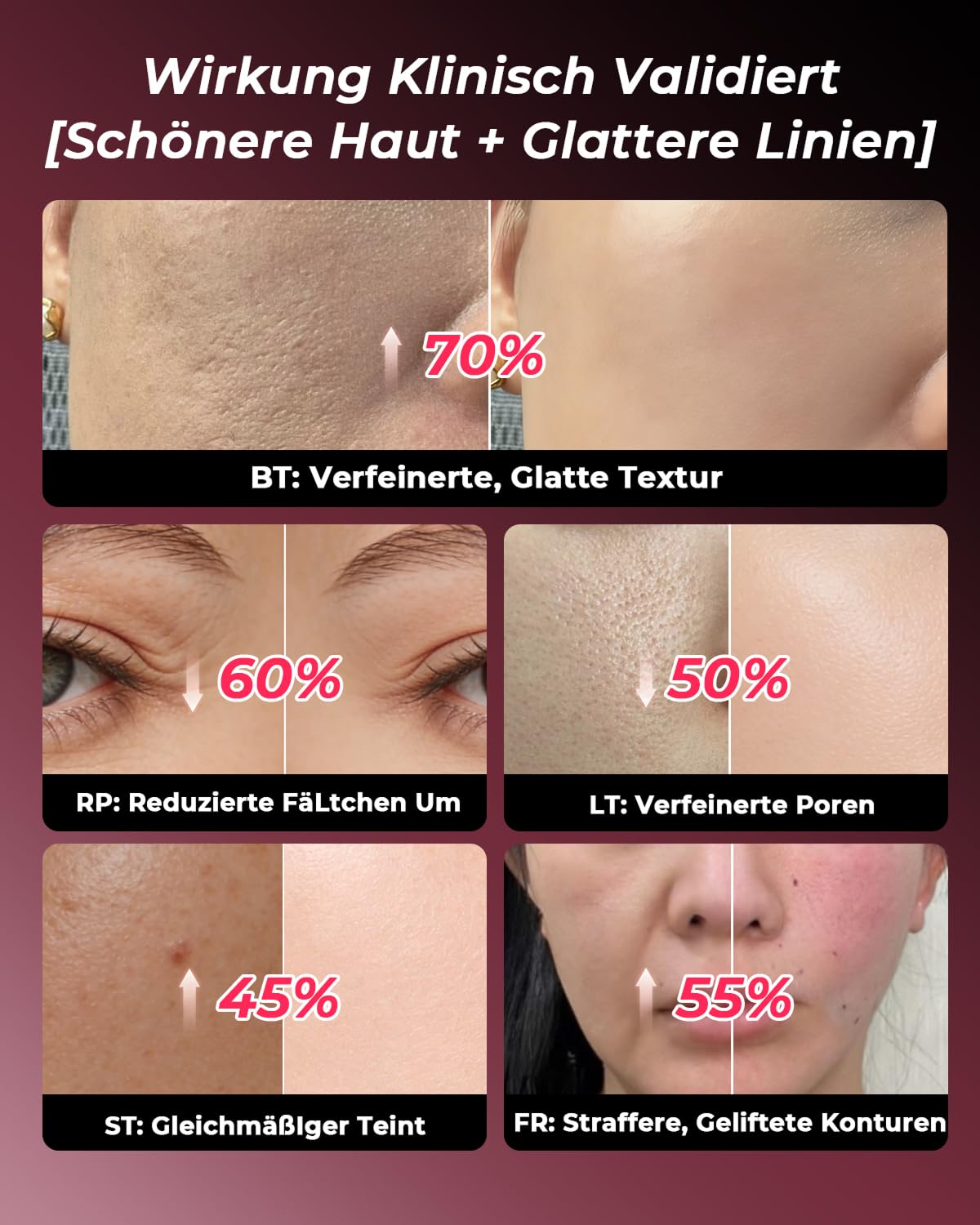 Gesichtsmassagegerät Radiofrequenz 5-in-1, EMS & Lichttherapie, Straffendes Lifting für Gesicht & Hals, Reduziert Falten, Feine Linien & Vergrößerte Poren, Anti-Falten, für Straffere Haut (Roségold)