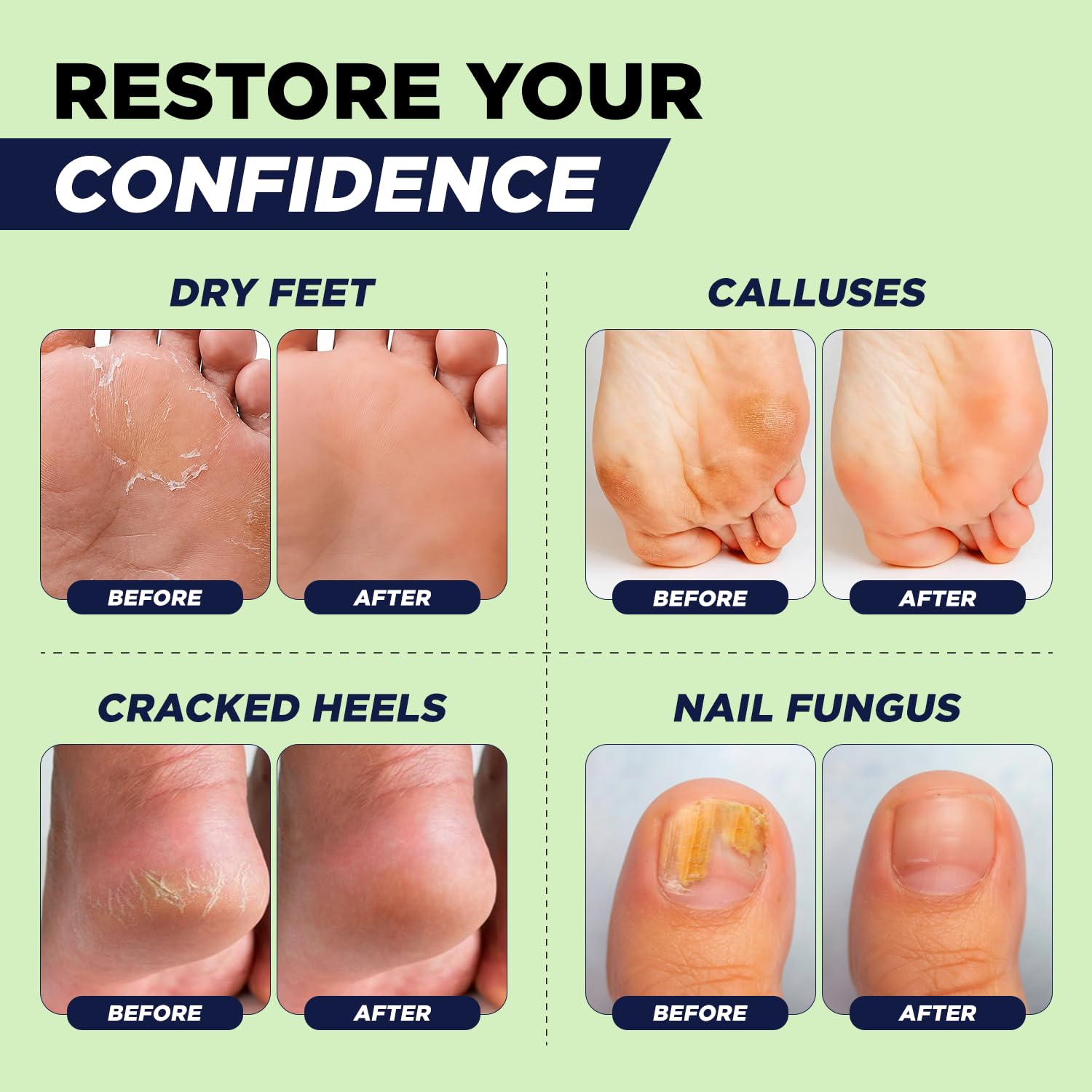 Juego de pedicura removedor de callos de pies – Epsom Salt Foot Soak & Gel removedor de callos, crema antimicótica y exfoliante de pies para piel muerta, herramientas de pedicura para pies en casa