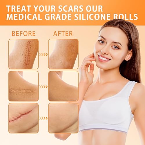 Miniatura 2 de Puzeku Cinta de silicona para cicatrices de 1.6 x 120 pulgadas de largo  Hojas de silicona para cicatrices de grado médico, cinta de cicatriz