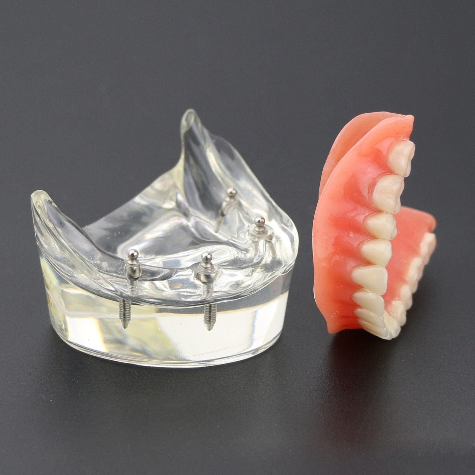 Modelo de sobredentadura Dental, modelo de dientes de enfermedad de implante, demostración de 2 implantes, para enseñar, estudiar, mostrar, comunicación con el paciente