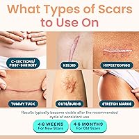 Vista 2 de Cinta de silicona prémium para cicatrices quirúrgicas, hojas de cicatrices de silicona reutilizables y profesionales, cinta médica para queloides