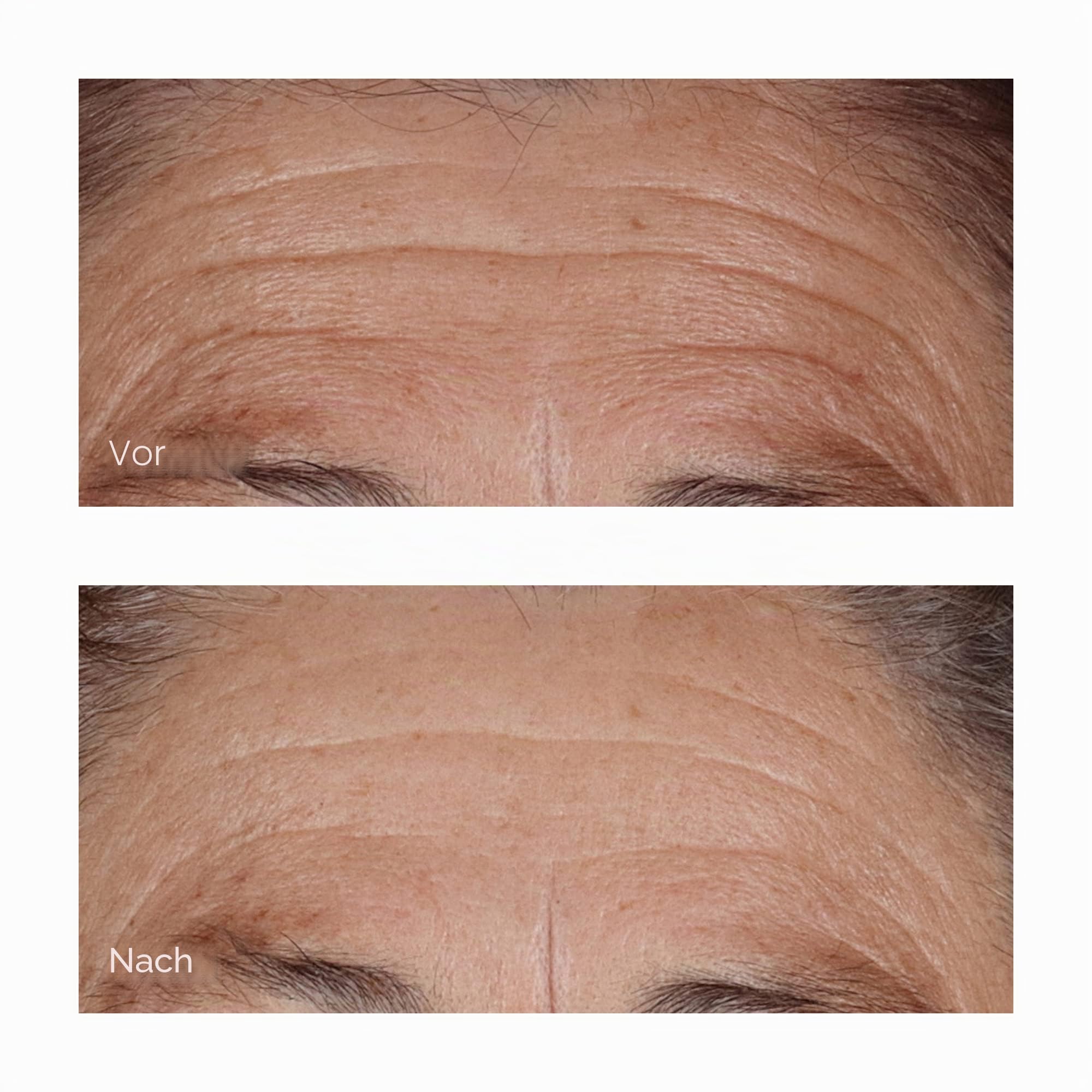Perricone MD High Potency Hyaluronic Intensive | Hyaluronic skincare to hydrate, plump and smooth dry or dehydrated-looking skin.