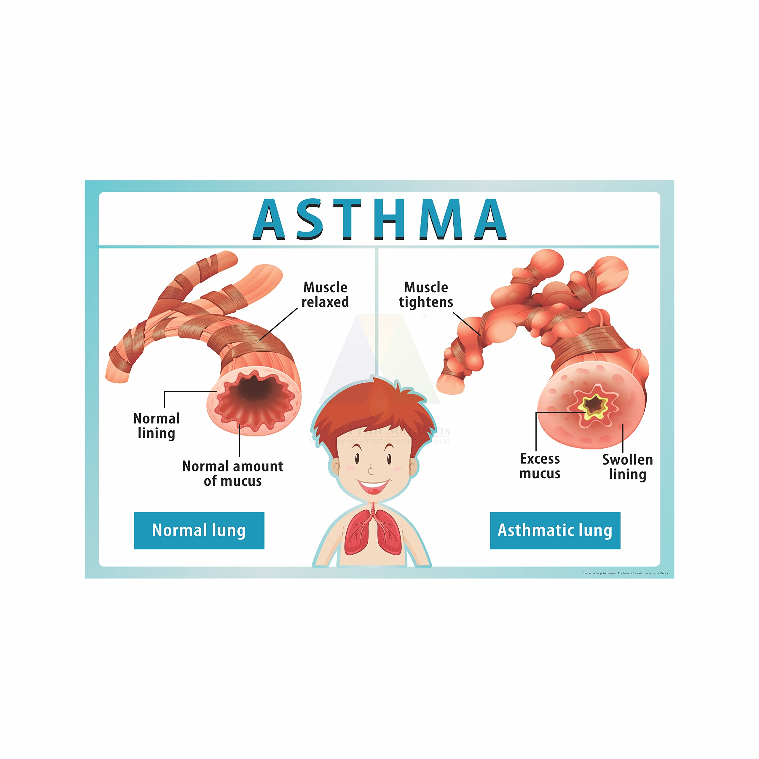 Anne Print Solutions® Asthma Poster (Without Frame) | Multicolour, 13 Inch X 19 Inch, For Hospital, Nursing Home, Clinic, Pack Of 1 Pcs