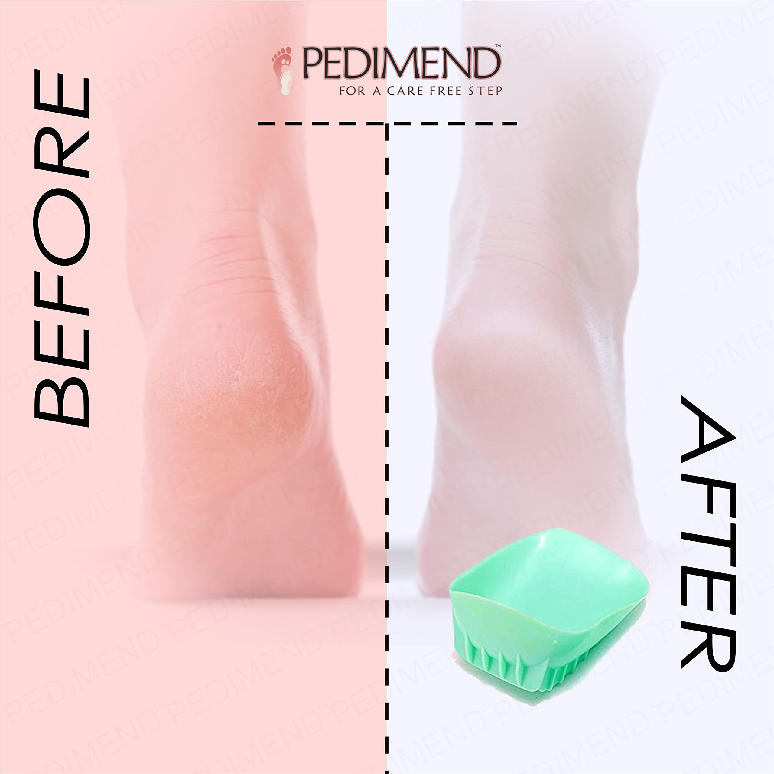 Pedimend Shock-Absorbing Heel Shells (One Pair) - Prevent Achilles Tenditis - Arch Support / Tibia Splints - Tibialis Posterior Syndrome, Achilles Tear Pain, Heel Pain, Heel Spur, Tibial Stress Breaks