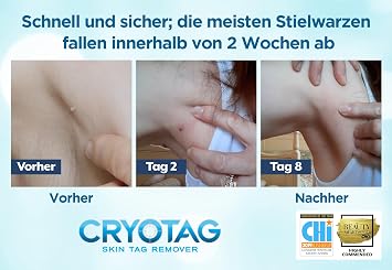 Cryotag Skin Tag Remover - Stielwarts Remover - Quick Effective Safe - Clinically Proven Icing Agent for Treating Stielwarts up to 12 Applications