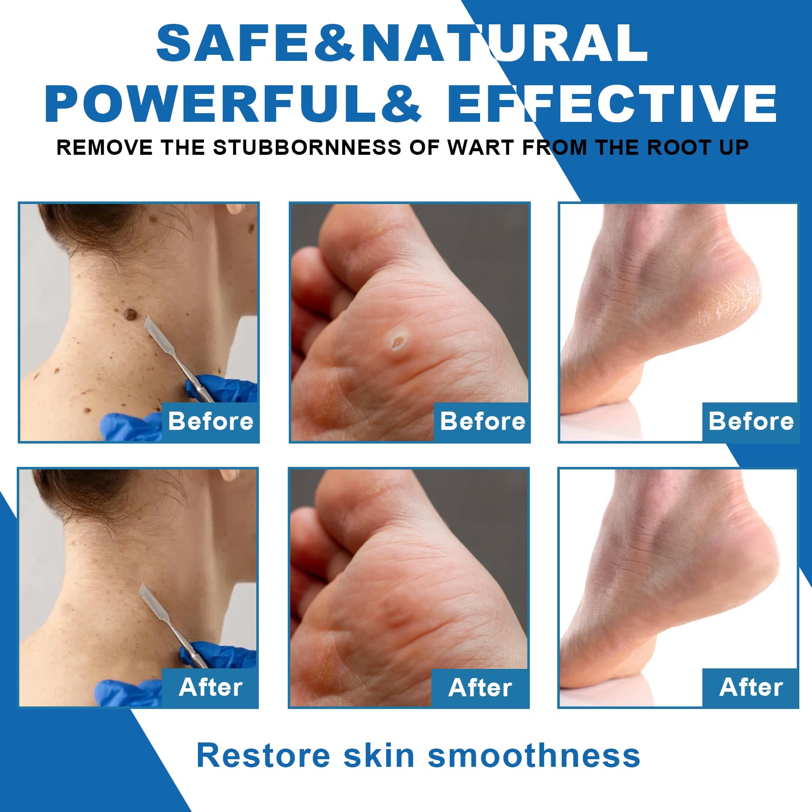 Gel para eliminar verrugas 20g - Aplicación precisa, adecuado para eliminar verrugas en el cuerpo y las manos, apto para todo tipo de piel