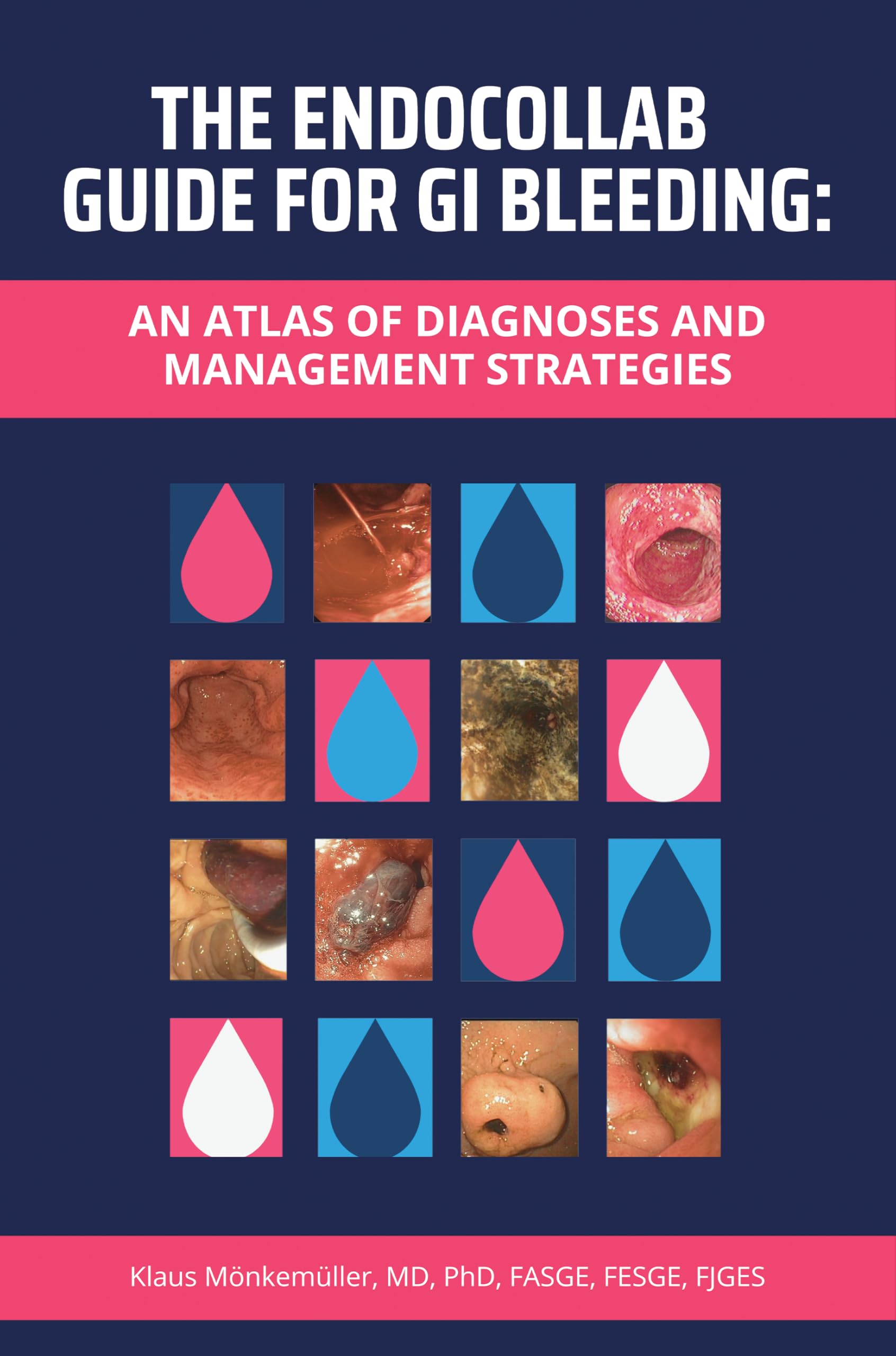 The EndoCollab Guide for GI Bleeding: An Atlas of Diagnoses and Management Strategies (English Edition)