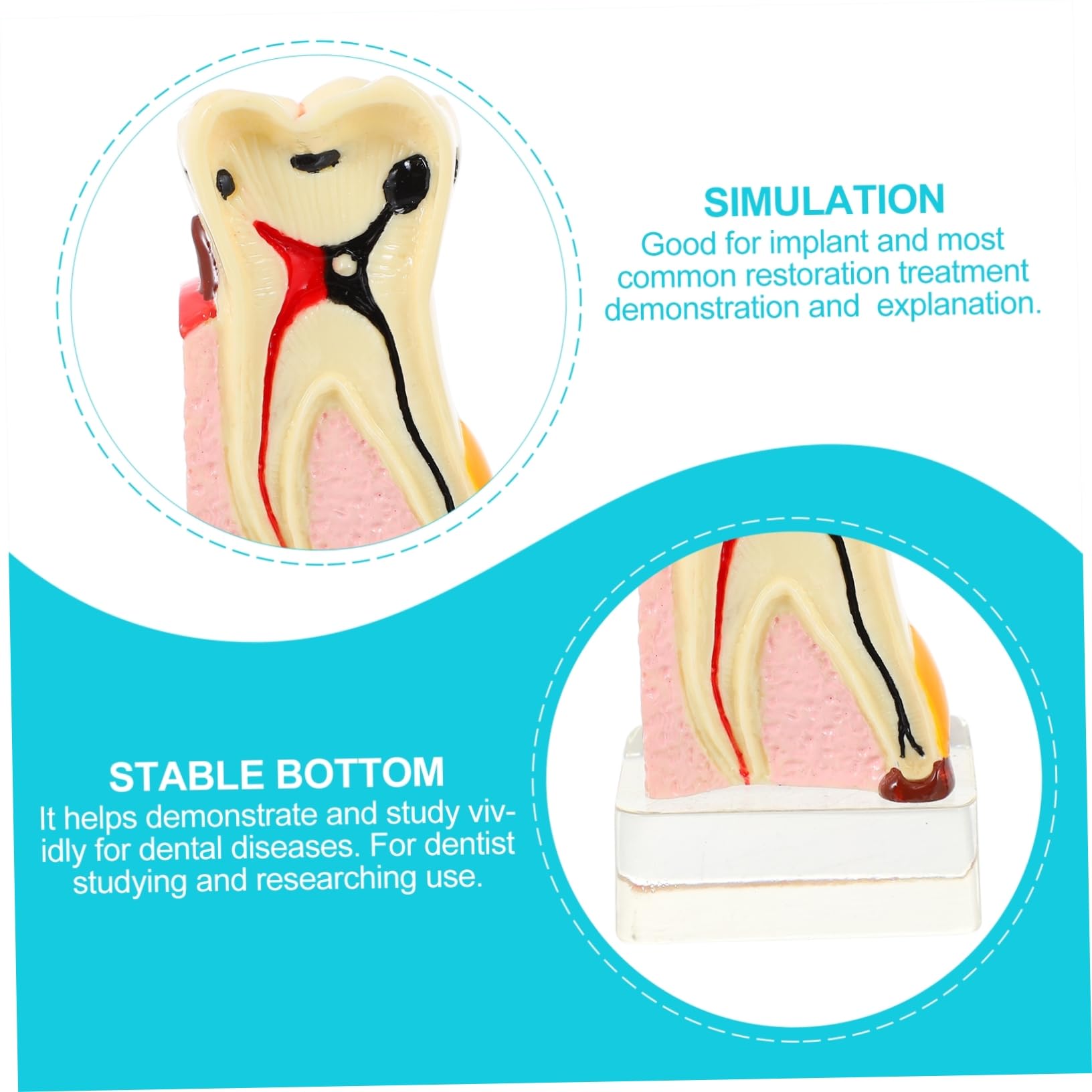 4volte Modello Anatomico di Carie per Studi Odontoiatrici Strumento Didattico per Insegnamento e Dimostrazioni Realizzato in Materiale
