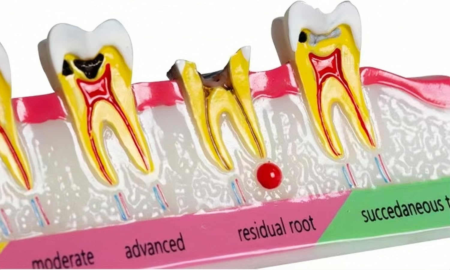 6-Stage Dental Caries Development Model - Anatomical Teeth Decay Demonstration with Color-Coded Labels for Dental Education, Patient Consultation & Teaching (Normal Decay Model)