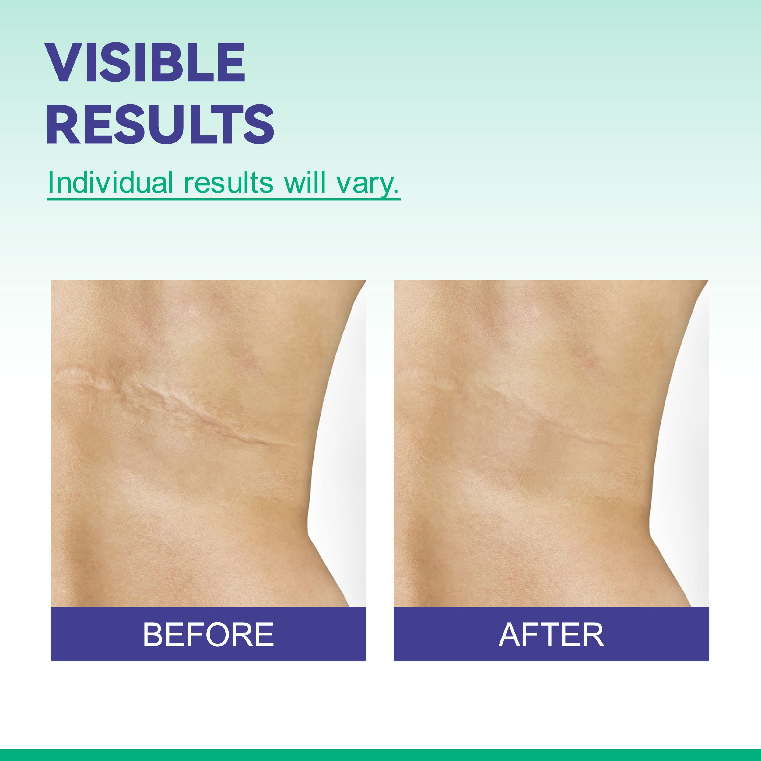 Silicone Scar Removal Sheets 2'' x 3'', for Body Scar, Cosmetic