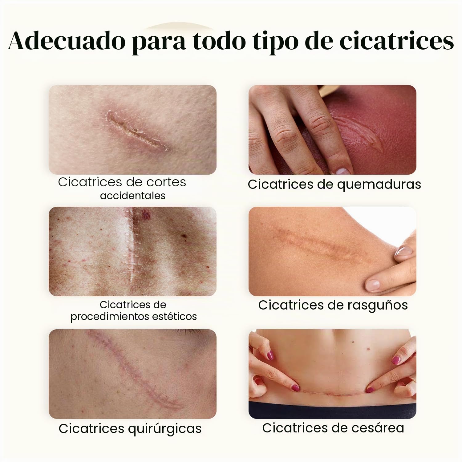 DERMATIX - Tratamiento y prevención de cicatrices - Cirugía, quemaduras - Gel de silicona - Tubo de 15 gramos