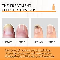 Vista 5 de Tratamiento de hongos en las uñas de los pies extra fuerte: tratamientos de hongos en las uñas de los pies, para uñas de los pies o uñas, solución