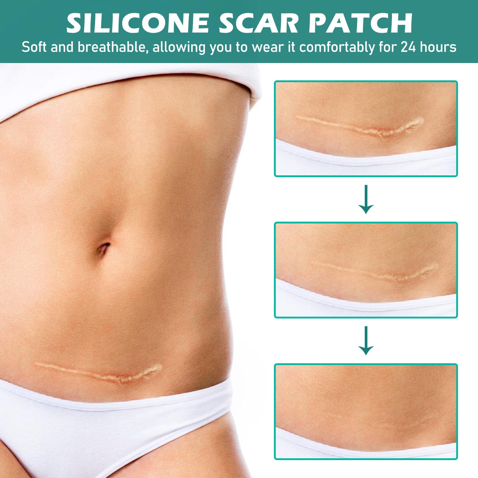 2 Rotoli Di Cerotti In Silicone Per Cicatrici (4x300 Cm) – Trattamento Per Cheloidi E Cicatrici Post-operatorie