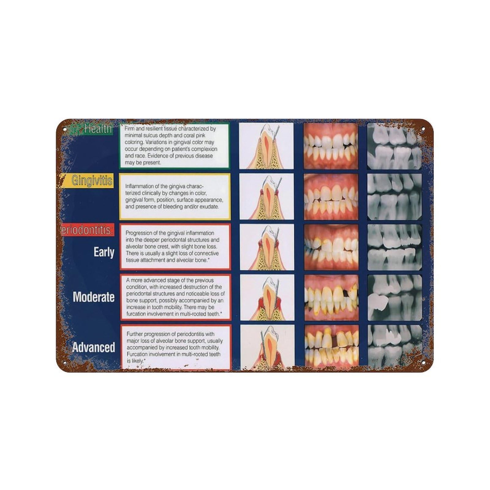 Dental Clinic Wall Poster Posters Of Stages Of Periodontal Disease Canvas Painting Posters Canvas Wall Art Prints for Wall Decor Room Decor Bedroom Decor Gifts 20x30cm Style