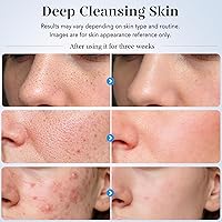 Vista 4 de GUGUG - Espátula para exfoliar la piel, espátula facial, limpiador de poros, herramientas removedoras de puntos negros con 4 modos para limpieza