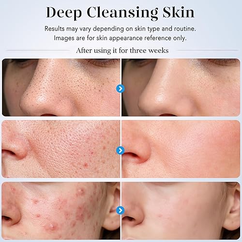 Miniatura 4 de GUGUG - Espátula para exfoliar la piel, espátula facial, limpiador de poros, herramientas removedoras de puntos negros con 4 modos para limpieza