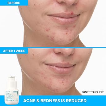 innisfree Gentle Retinol Salicylic Acne Serum | Korean Face Treatment with Niacinamide and Ceramides for Blemishes and Clear Skin