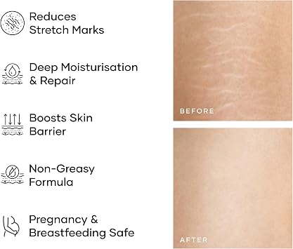 Cureskin Smoothing Body Butter Stretch Marks Cream for Women and Men | Stretch Marks Removal Cream for Women, 100 g (Pack of 1)