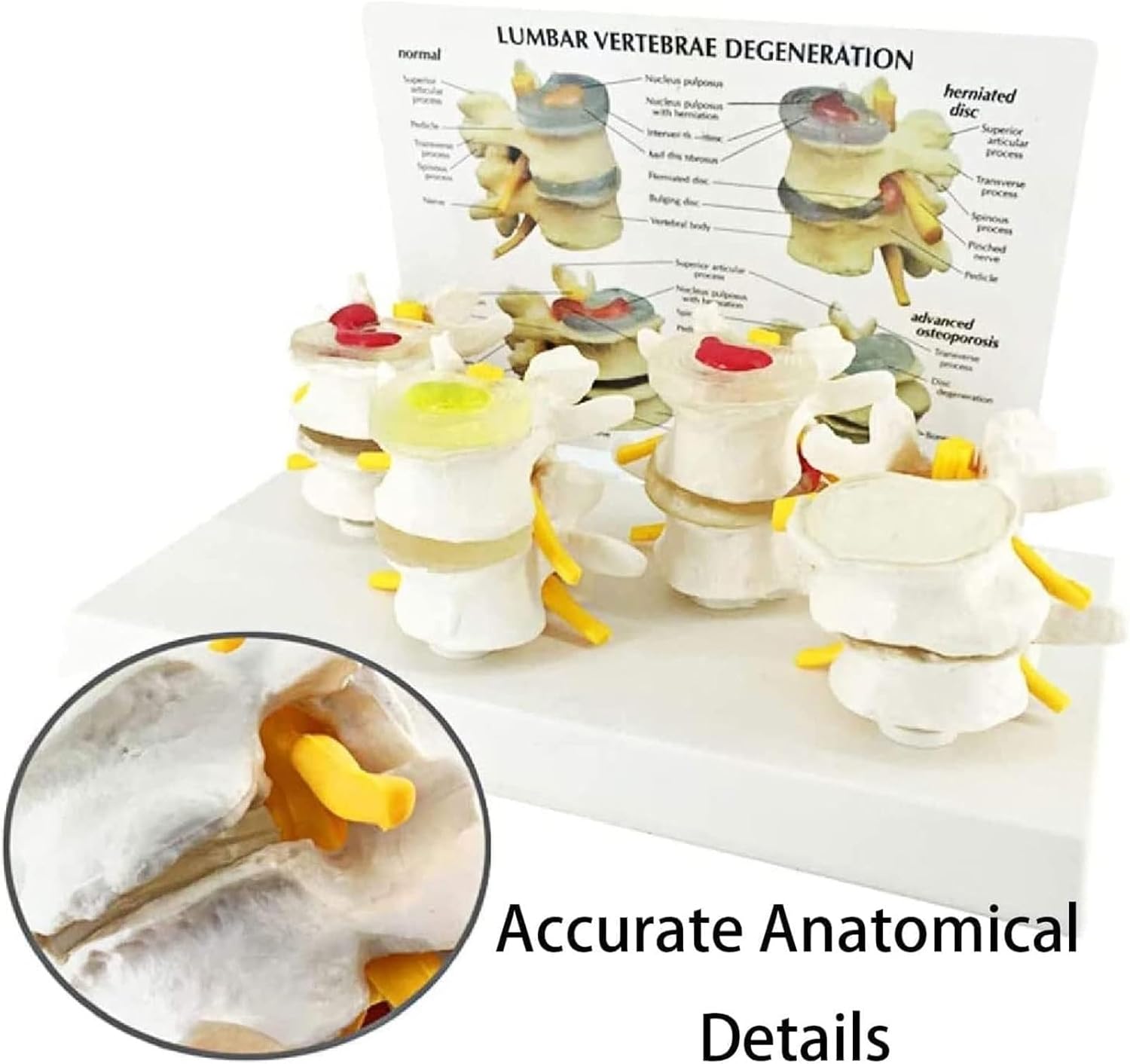 Human Spine Model, 4-Stage Diseased Lumbar Spine Comparison Model,Display Herniated Disc, Bone & Disc Degeneration, & Advanced Osteoporosis,with English Back Card
