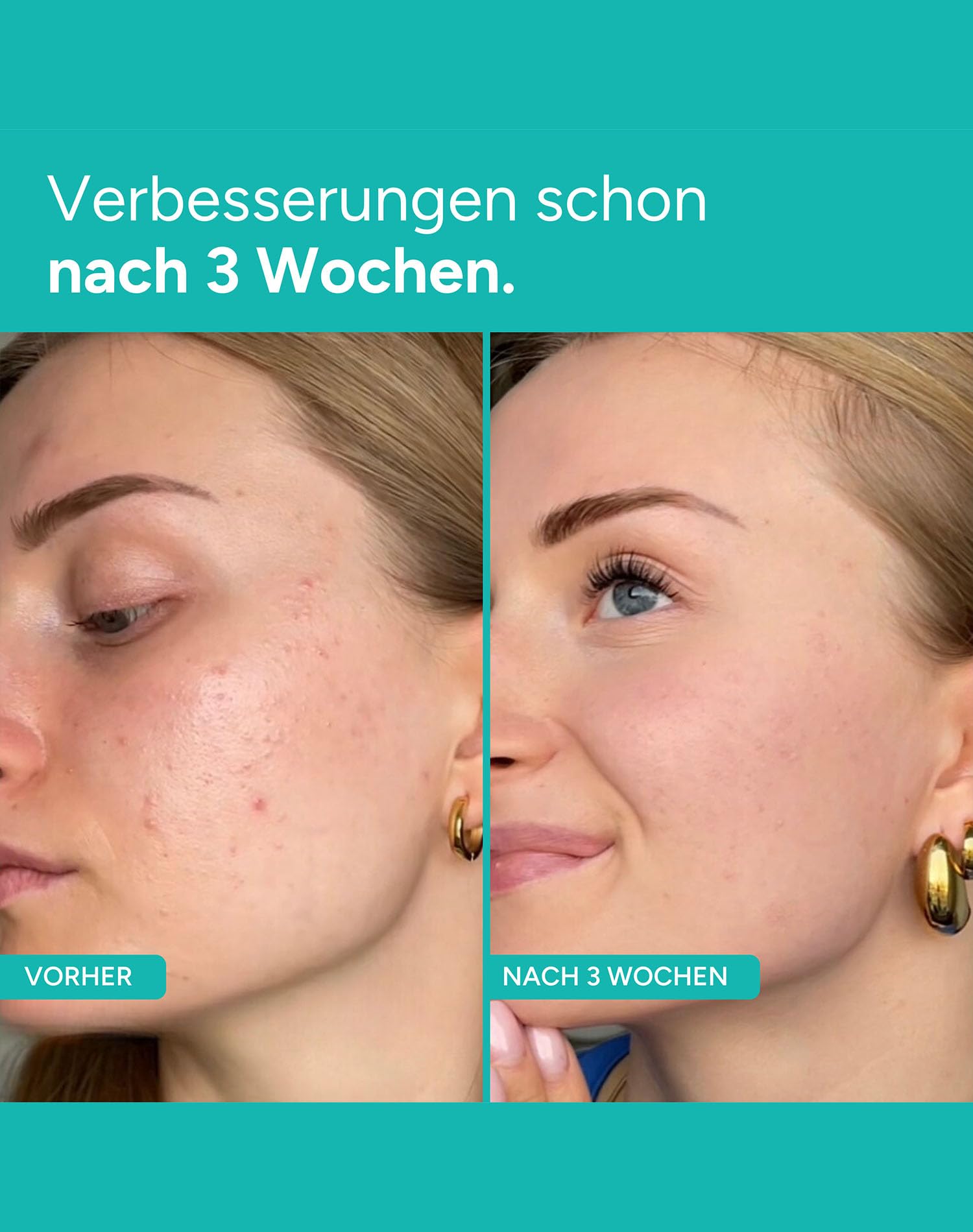 Kaltplasma Kosmetikgerät GLIM90 Schwarz Gesicht Hautpflegegerät Porenreiniger Anti Pickel Beautygerät pflegt empfindliche unreine Haut verbessert Hautbild glatte strahlende Haut