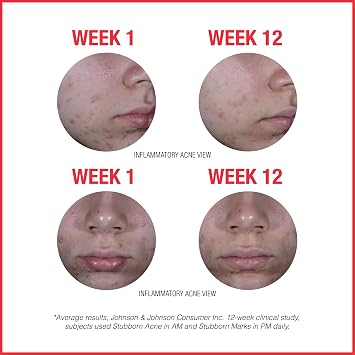 Neutrogena Stubborn Acne AM Face Treatment with Benzoyl Peroxide, 2.0 oz & Stubborn Marks PM Treatment with Retinol SA, 1 fl. oz