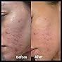 Eofot 14% Azelaic Acid Acne Cream, Azelaic Acid For Face, Helps Improve the Appearance of Acnes - Azalecic Acids Acido Azelaico, 1 Fl Oz