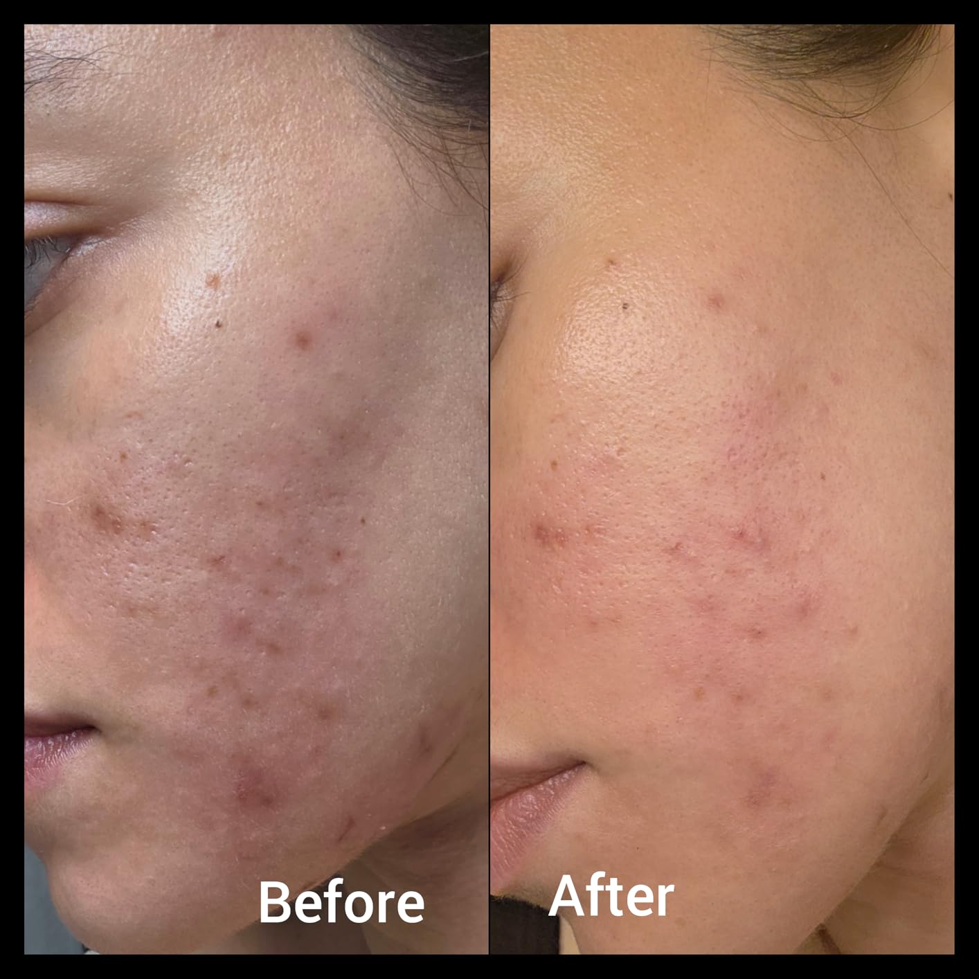 Eofot 14% Azelaic Acid Acne Cream, Azelaic Acid For Face, Helps Improve the Appearance of Acnes - Azalecic Acids Acido Azelaico, 1 Fl Oz