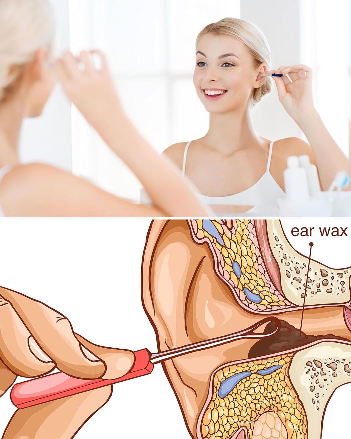 5Pcs Professionale Rimuovi cerume Di acciaio inossidabile- Strumento Curette Orecchie A Rimuovere l'irrigazione Dell'orecchio, Detergente per Orecchie Igienico Riutilizzabile per Adulti