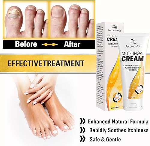 Miniatura 4 de Crema antifúngica Tratamiento de pies de atletas - Tratamiento Versicolor de tiña - Crema de comezón jock - Tratamiento de pies de atletas extra