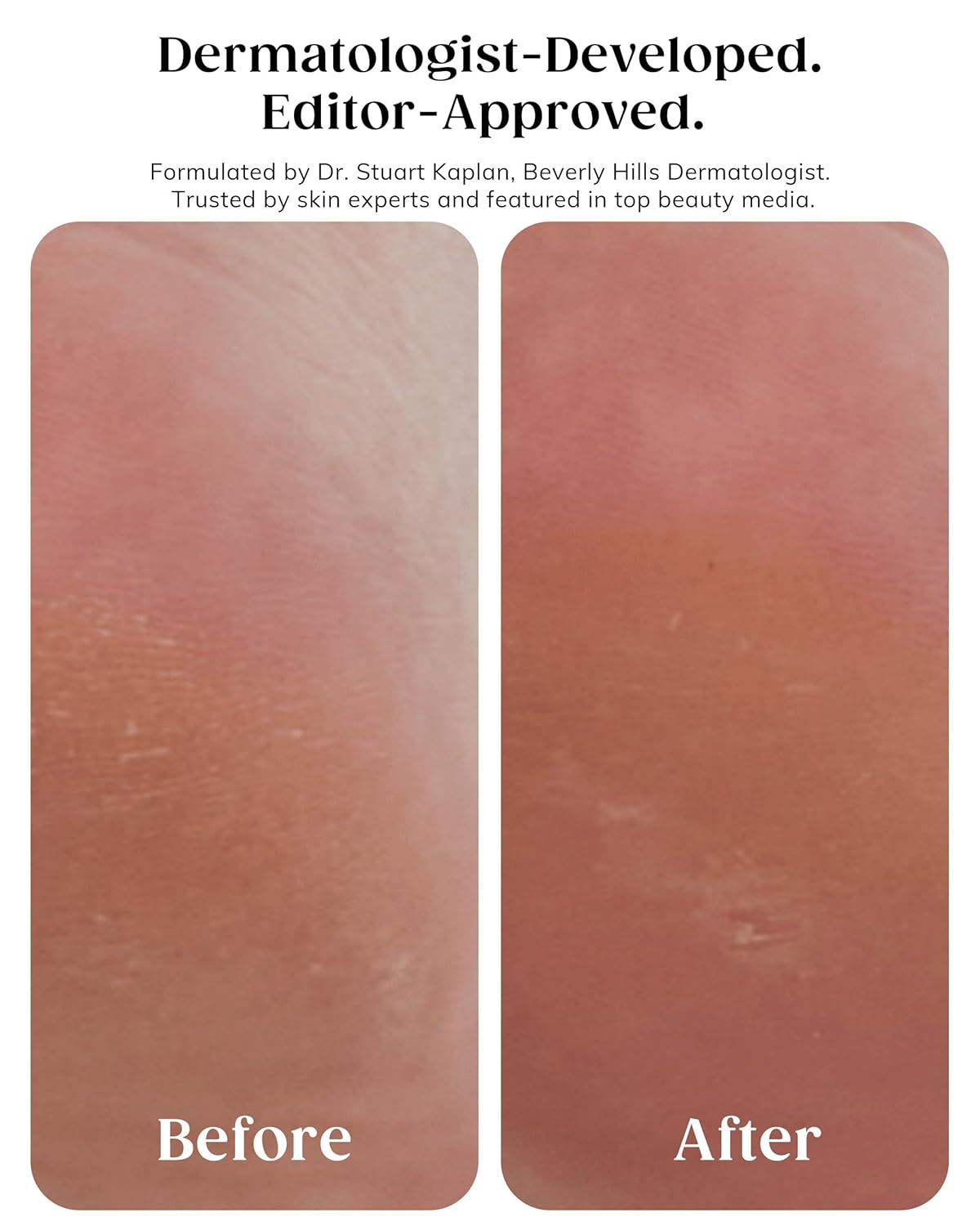 KAPLAN MD Diamond Contour Insta-Glow Gommage Body Peel – Body Exfoliator & Skin Peel with Glycolic Acid, Pineapple Ceramides & Crushed Diamonds - Exfoliating for Smooth, Radiant Skin, 10.14 fl oz - Image 2