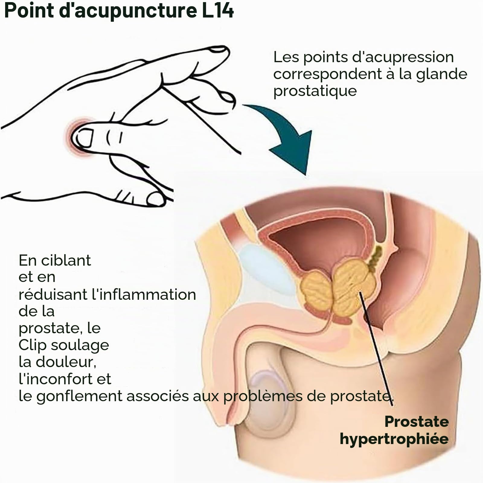 Clip de Point de Soin de la Prostate, soulage l'inconfort de la Prostate sans Effort et maintient la santé de la Prostate, Clip de Point d'acupuncture L14