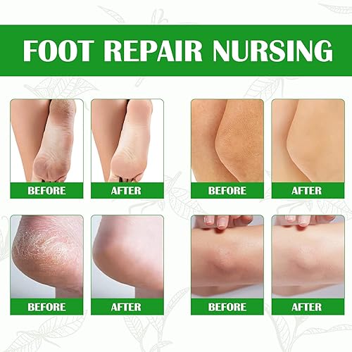 Miniatura 5 de Removedor de callos para pies, espray instantáneo para pelar los pies, limpiador de pies, removedor de piel muerta suavizante de talones agrietados,
