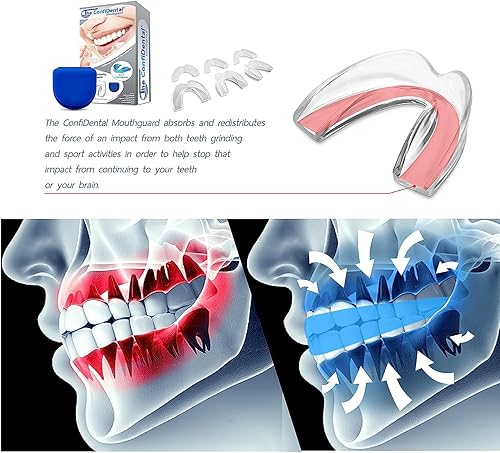 Miniatura 24 de The ConfiDental - Paquete de 3 protectores bucales moldeables para rechinar dientes, apretar bruxismo, deporte atlético, bandeja blanqueadora, Negro