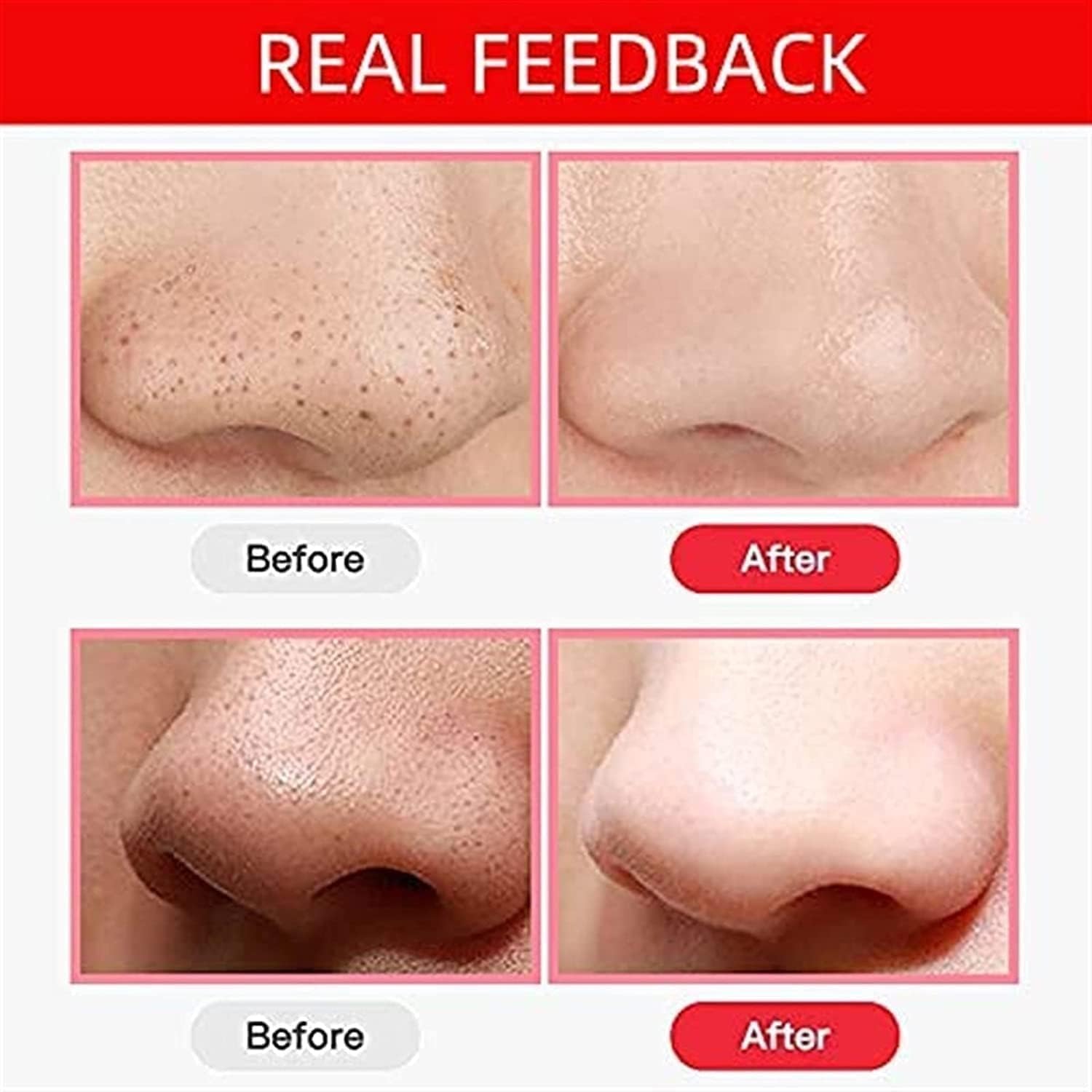 Blackhead Remover Vacuum, Acne Comedone Extractor Tool USB Rechargeable Pore Cleaner Electric Blackhead Suction Instrument with 3 Adjustable Suction Power and 3 Replacement Probes
