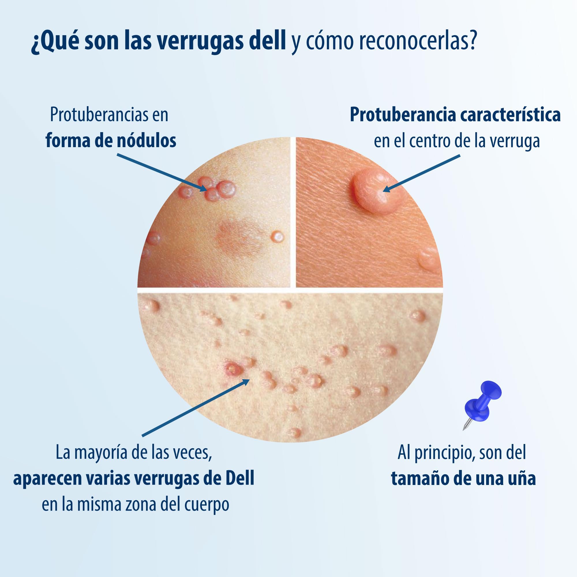 Evolsin® Remedio para el molusco contagioso I Para adultos y niños a partir de 2 años I Tratamiento suave y eficaz del molusco contagioso