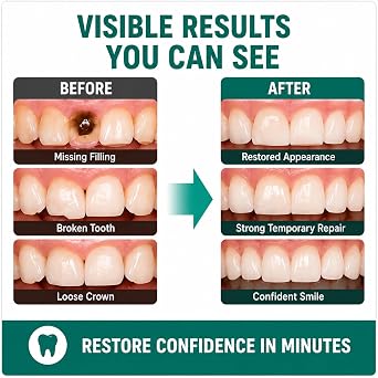 Zinc Oxide Eugenol Cement Dental kit for Fixing Temporary Crowns and Bridges, Keeping Your Smile Intact, Temporary kit