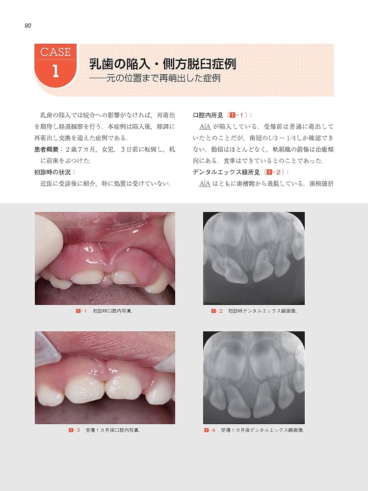 これで安心！ 乳歯・幼弱永久歯の外傷への対応―保存か抜歯かを