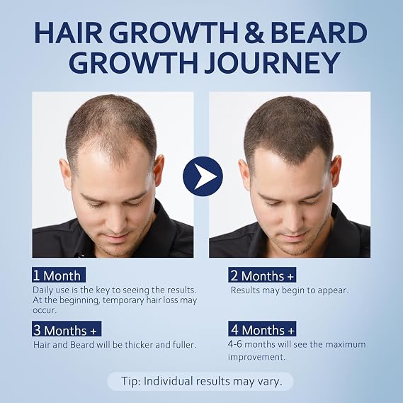 5% Minoxidil Hair Growth Serum for Men & Women with Biotin: Minoxidil for Men and Women, 5 Percent, Hair Regrowth Treatment, Extra Strength (12 FL OZ, Dropper 6)
