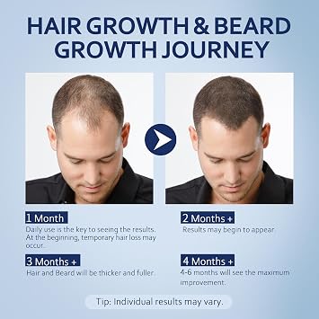 5% Minoxidil Hair Growth Serum for Men & Women with Biotin: Minoxidil for Men and Women, 5 Percent, Hair Regrowth Treatment, Extra Strength (12 FL OZ, Dropper 6)