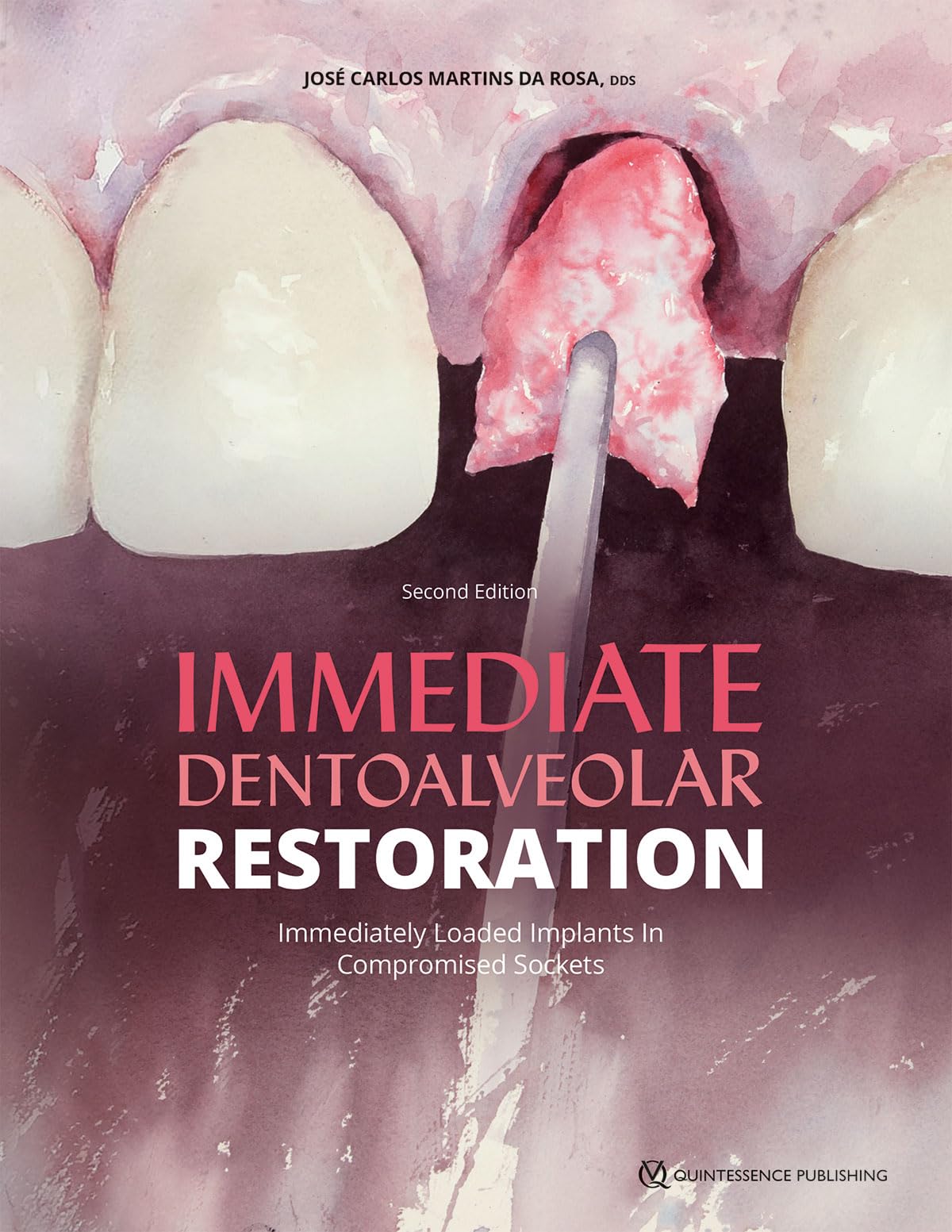 Immediate Dentoalveolar Restoration: Immediately Loaded Implants in Compromised Sockets