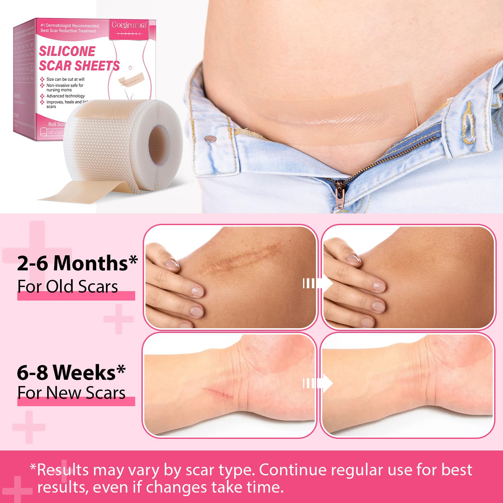 Silicone Scar Tape Medical Grade - 1.6 X 120 Inch Roll For Surgical & C-Section Scars Tuck Tape