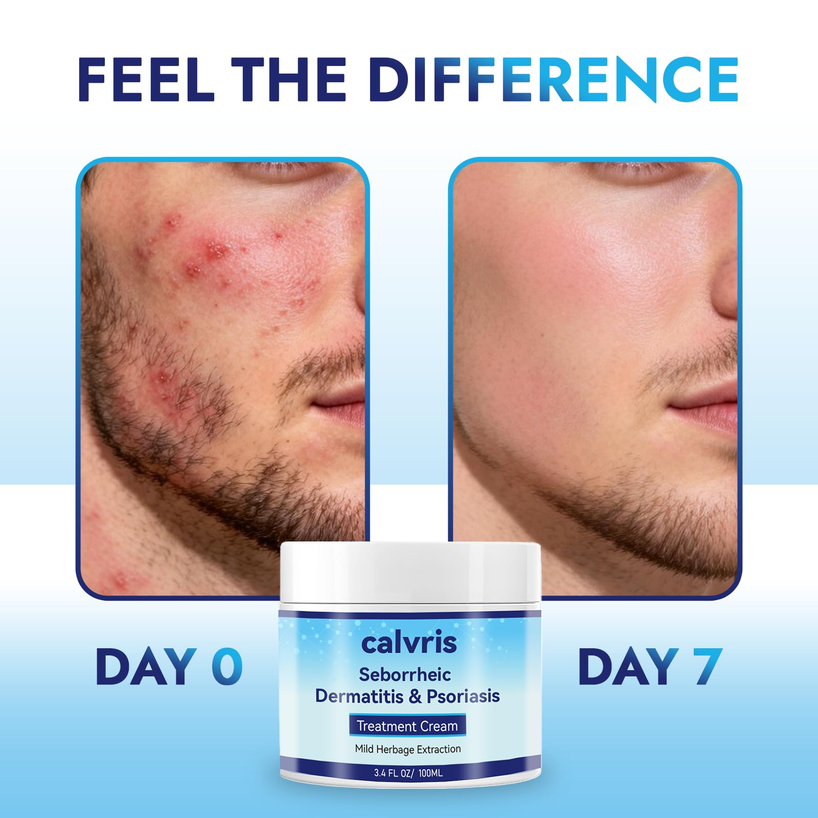 Scalp Comfort Balm – Steroid-Free Botanical Formula for Dry, Itchy Scalp & Skin