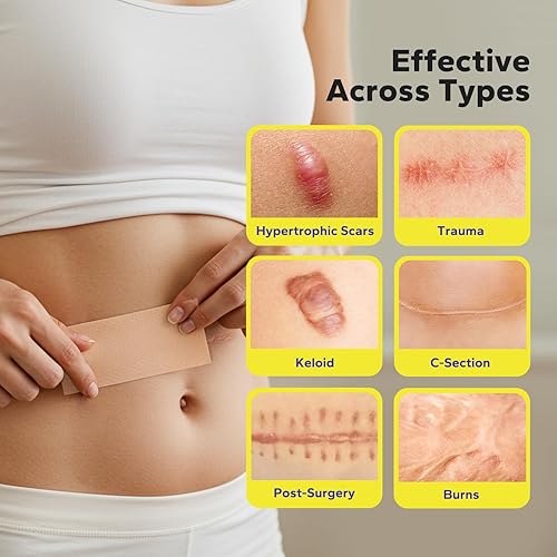 Miniatura 4 de Hojas de silicona para cicatrices (rollo de 1.6 x 60 pulgadas - 1.5 M), cinta de silicona para cicatrices quirúrgicas, queloides y cicatrices de