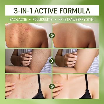 ABERA High-Performance Folliculitis BHA Shower Gel with Wild Bitter Melon Extract & Tea Tree Oil, Acne Body Wash, Reduce Back Acne & KP, Healthy Skin for Men & Women, 3 Pack (10.14 Oz per Item)