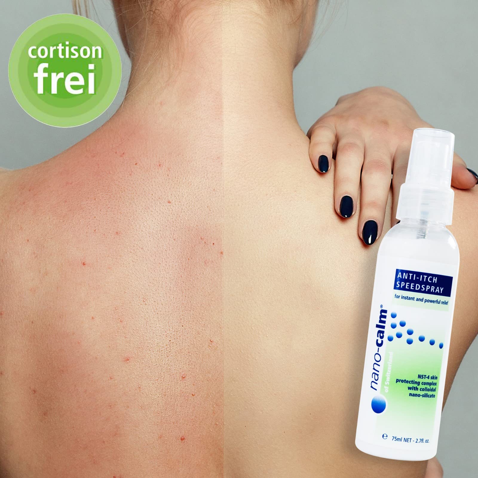 Medskina Neurodermitis Spray 75 ml - Hilfe bei Psoriasis Schuppenflechte und trockener Haut - Spray gegen Hautpilz und Juckreiz - Wundspray schnelle Wundheilung - MADE IN SWISS