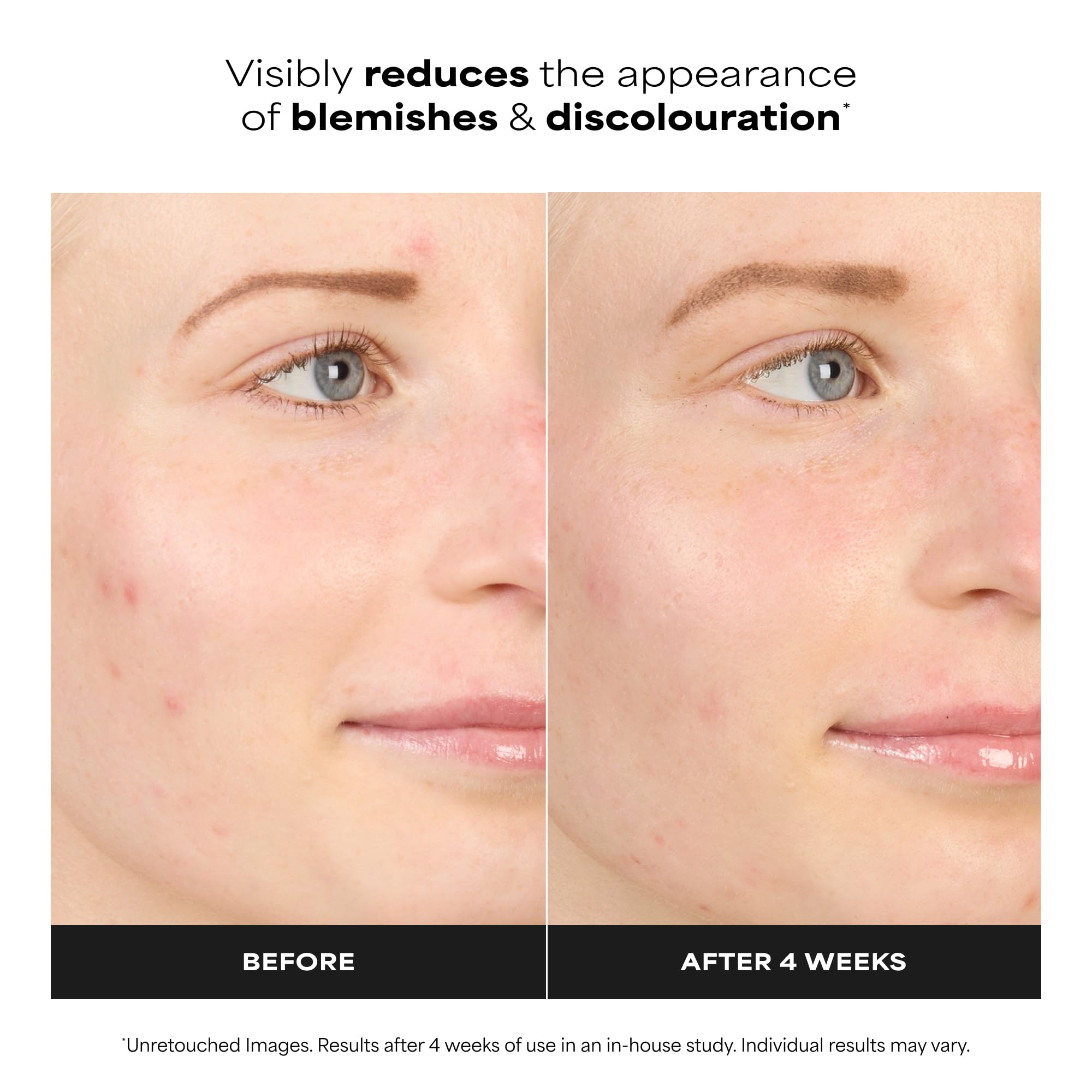 Paula's Choice 10% Kwasem Azelainowy BOOSTER - Serum do Twarzy Rozjaśnia Brązowych Przebarwień & Zwalcza Wypryski - z Salicylowym - Wszystkie Rodzaje Skóry - 30 ml
